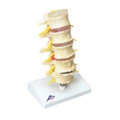 3bScientificAnatomicalModel-VertebraeDegeneration,StagesOfProlapsedDisc-AnatomicalModel-VertebraeDegeneration,StagesOfProlapsedDisc