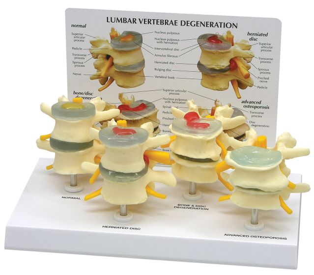 4 Stages Of Lumbar Degeneration - Model