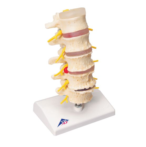 Stages Of Disc Prolapse & Vertebral Degeneration