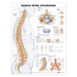 HumanSpineDisoders20X26Laminate