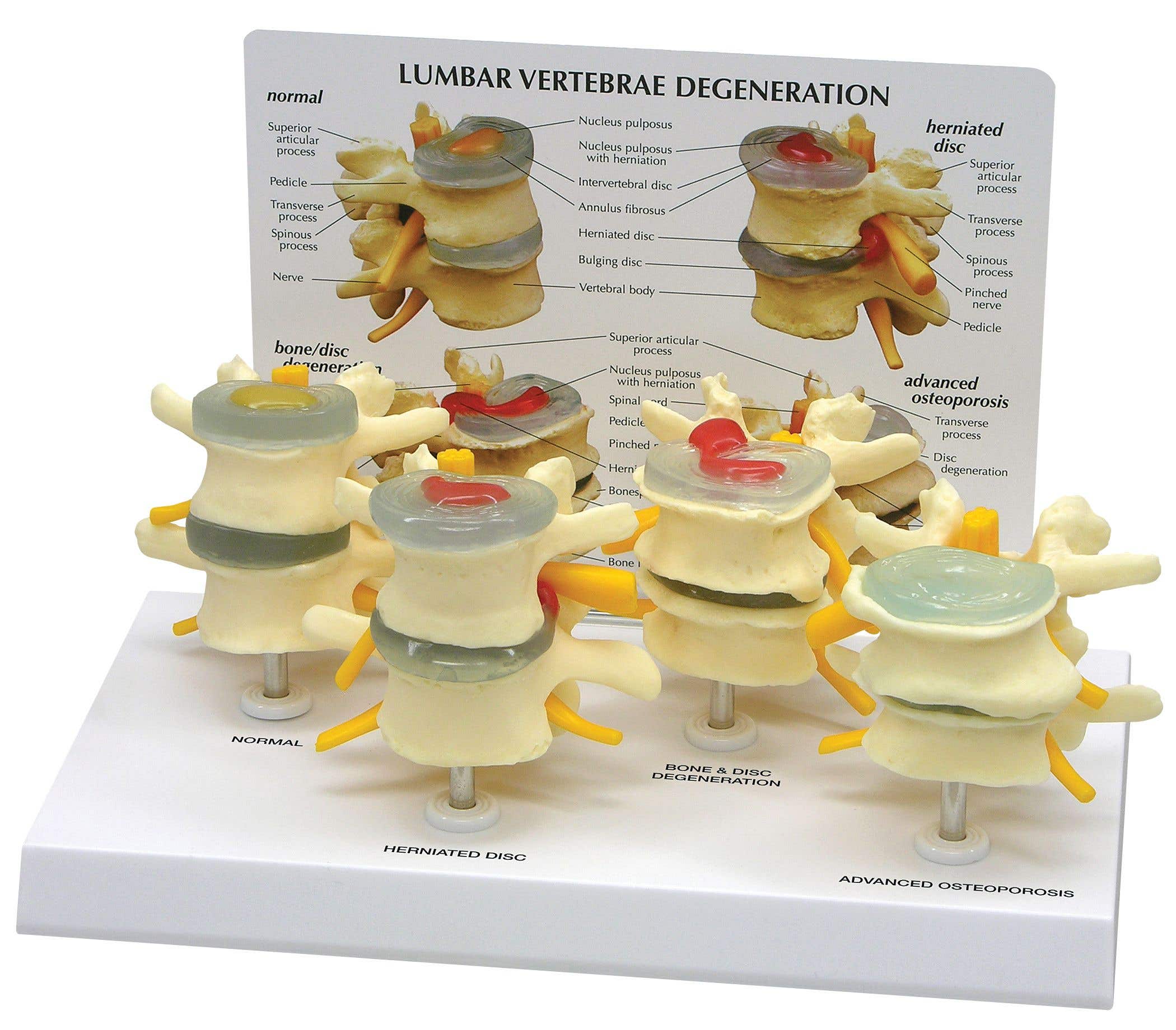4StagesOfLumbarDegeneration-Model